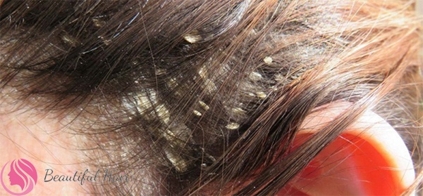 Các bệnh lý da đầu gây rụng tóc