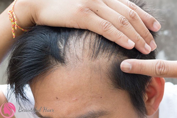 Cảnh báo những triệu chứng rụng tóc ở nam giới đáng chú ý