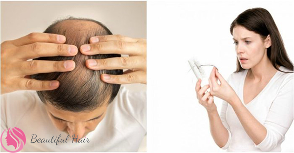 rụng tóc là dấu hiệu mắc bệnh lupus ban đổ hệ thống
