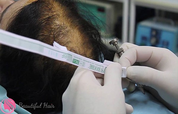 Cấy tóc sinh học BioFibre