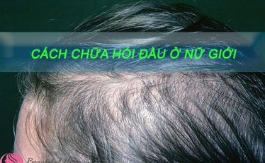 top-3-cach-chua-hoi-dau-o-nu-gioi-cuc-ki-hieu-qua