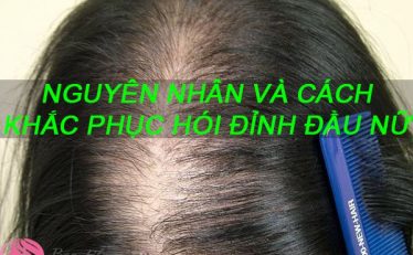 hoi-dinh-dau-nu-nguyen-nhan-va-cach-khac-phuc-hieu-qua