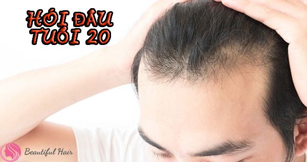 Rụng tóc ở nam tuổi 20 nguy cơ hói đầu cao