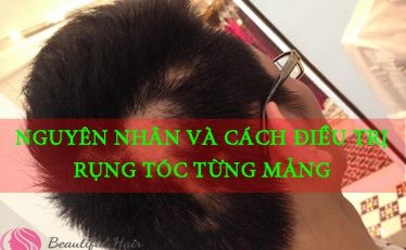 nhung-dieu-can-biet-khi-co-dau-hieu-rung-toc-tung-mang