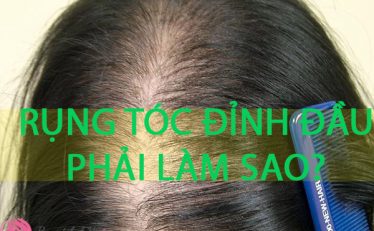 toc-rung-nhieu-o-dinh-dau-phai-lam-sao