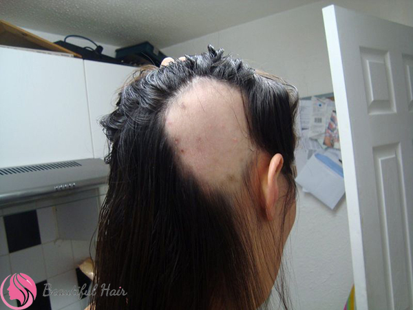 Các triệu chứng phổ biến của rụng tóc từng mảng