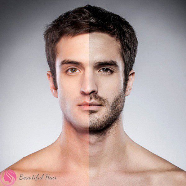 Phương pháp cấy râu tự thân là gì