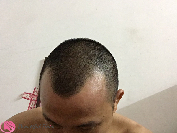 Rụng tóc nam giới: Nguyên nhân và cách điều trị - Cấy Tóc Quốc Tế