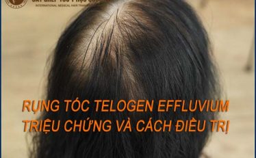 rung-toc-telogen-effluvium