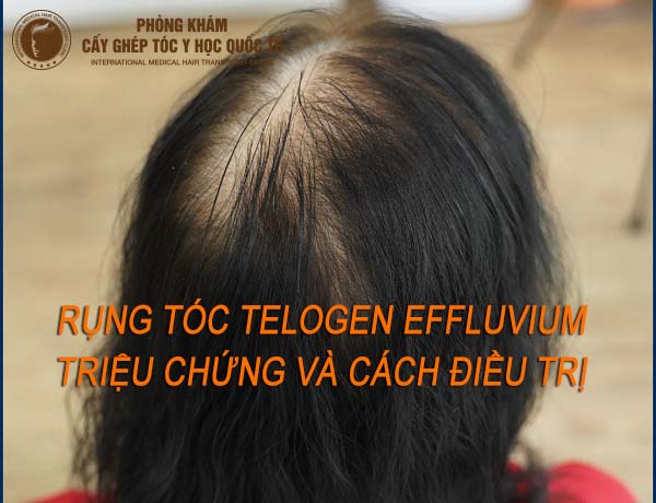 rụng tóc telogen effluvium