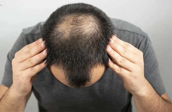 hói đỉnh đầu