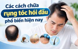 tim-hieu-cac-cach-chua-rung-toc-hoi-dau-pho-bien-hien-nay