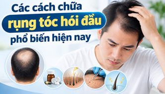 tim-hieu-cac-cach-chua-rung-toc-hoi-dau-pho-bien-hien-nay