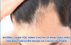 duong-chan-toc-hinh-chu-m-co-phai-dau-hieu-hoi-dau