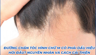 duong-chan-toc-hinh-chu-m-co-phai-dau-hieu-hoi-dau