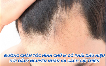 duong-chan-toc-hinh-chu-m-co-phai-dau-hieu-hoi-dau