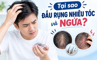 chuyen-gia-giai-dap-tai-sao-dau-rung-nhieu-toc-va-ngua