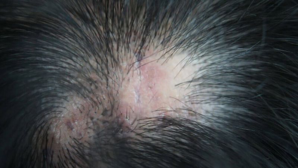 nguyên nhân gây rụng tóc ngứa da đầu
