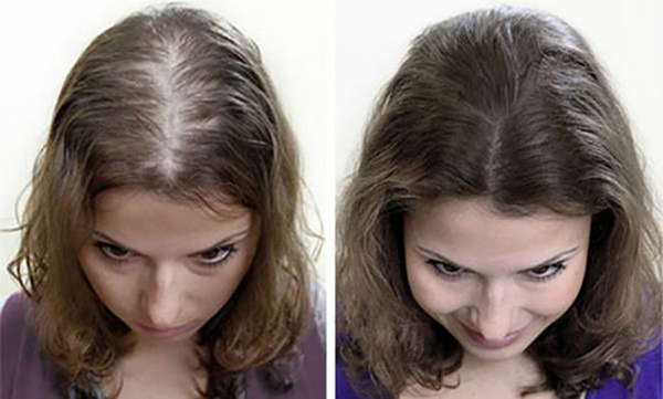 cấy tóc cho nữ bị rụng tóc lâu năm