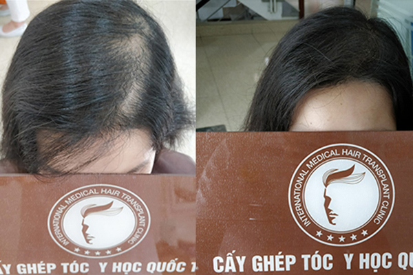  Cách điều trị đầu rụng nhiều tóc và ngứa an toàn, hiệu quả