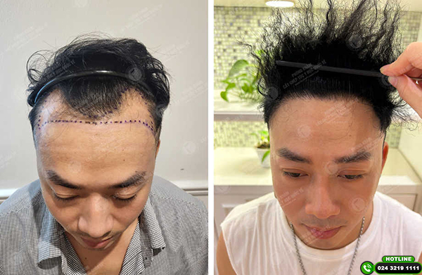 cấy tóc nam