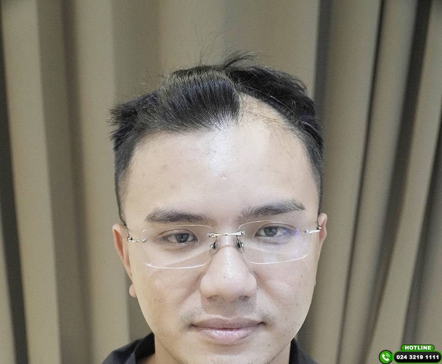 dấu hiệu đường chân tóc chữ m 