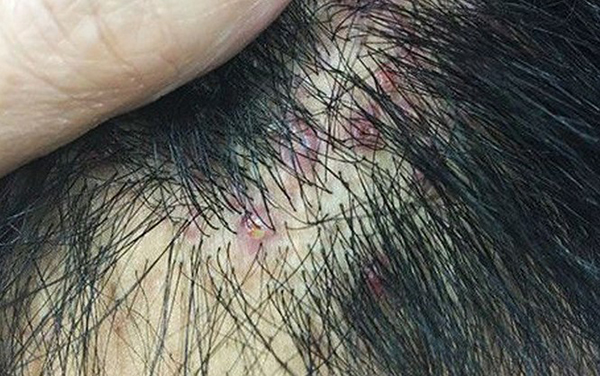 nguyên nhân gây rụng tóc ngứa da đầu
