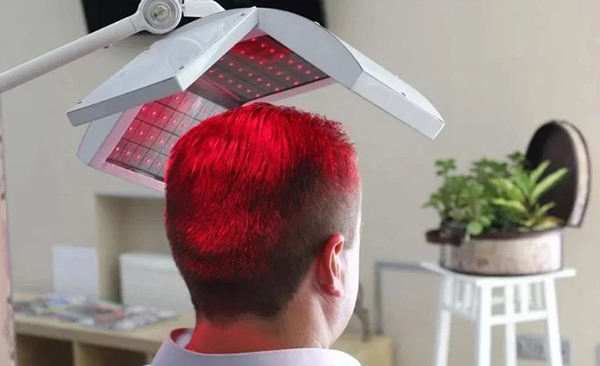 điều trị hói đầu bằng laser