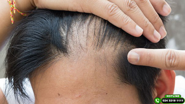 rụng tóc nhiều ở nam