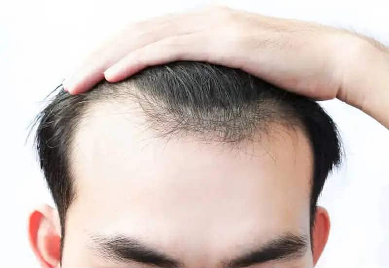vì sao đường chân tóc có hình chữ m 